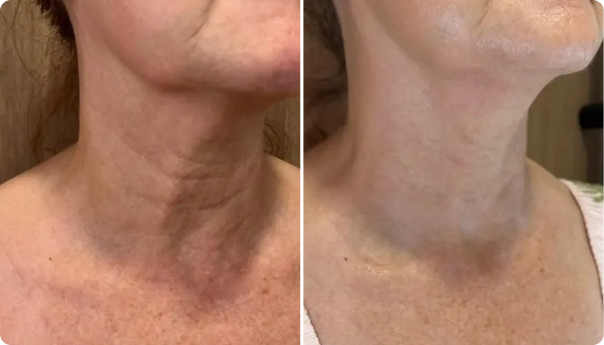 Cheryl before and after using RenewaCell