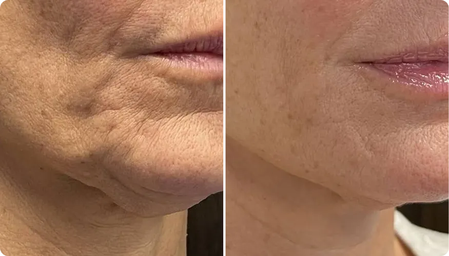 Kathy before and after using RenewaCell