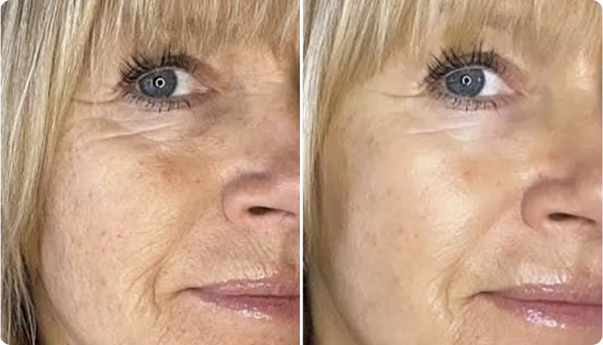 Jenna before and after using RenewaCell