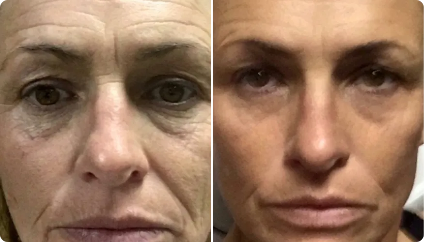 Gwen before and after using RenewaCell