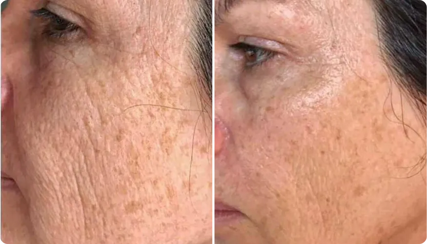 Olivia before and after using RenewaCell