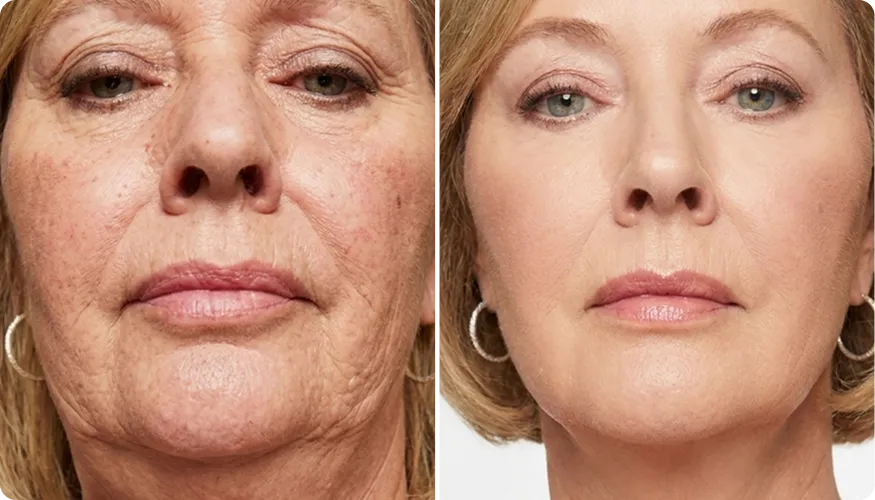 Mary before and after using RenewaCell