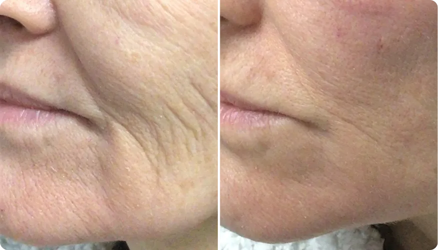 Tracy before and after using RenewaCell