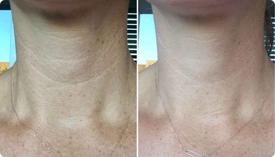 Nicole before and after using RenewaCell