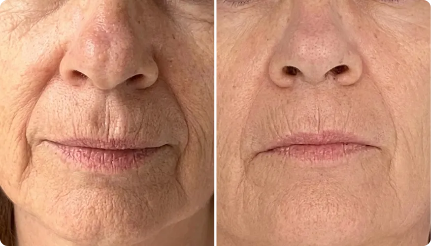 Diana before and after using RenewaCell