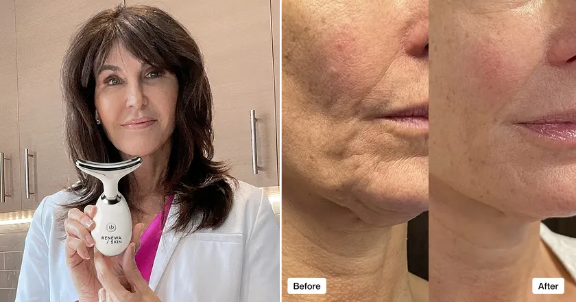 Dr. Ellen Turner with RenewaLift and neck before and after results