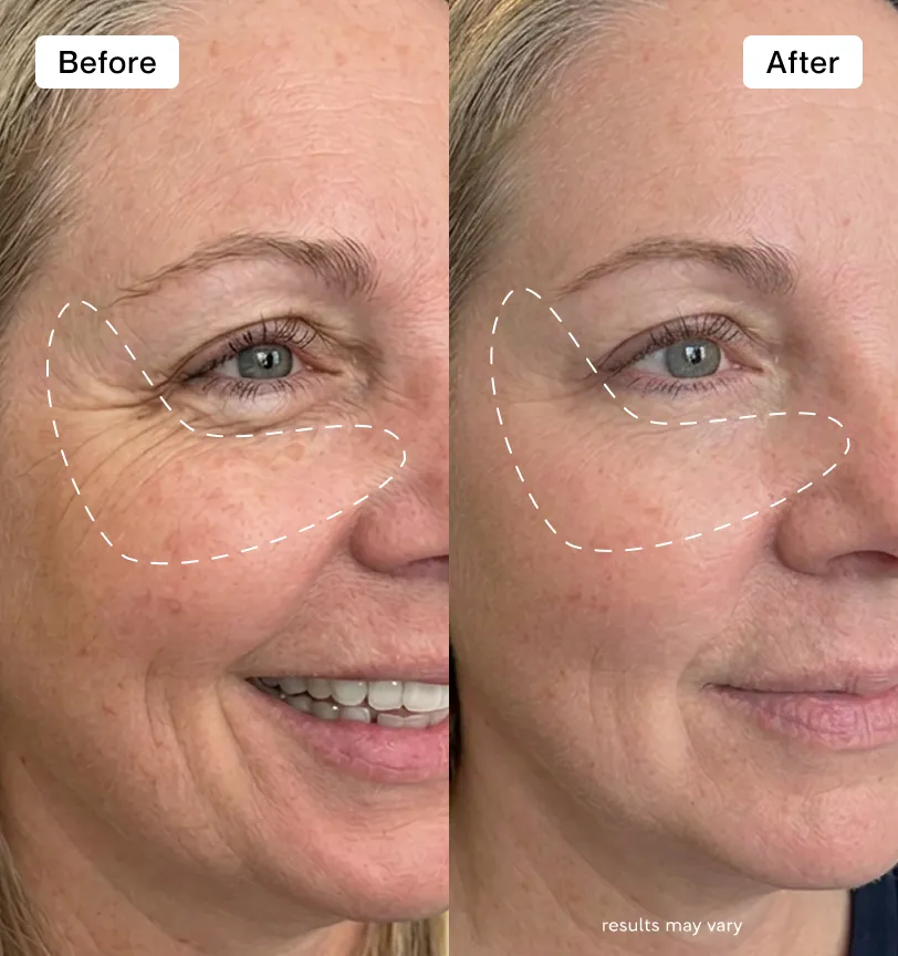 I can see my wrinkles becoming less visible