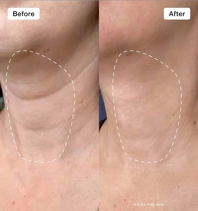Fantastic results with my crepey neck