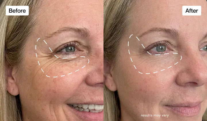 I can see my wrinkles becoming less visible