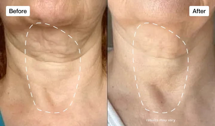 Changes in my neck area