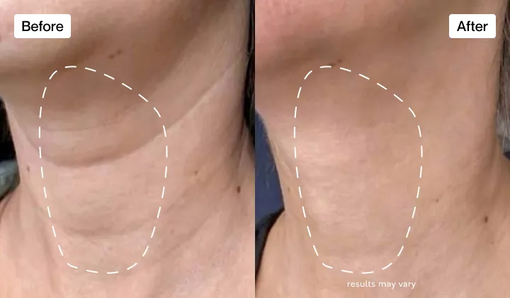 Fantastic results with my crepey neck