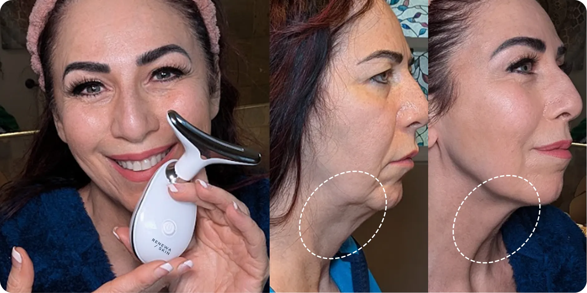 RenewaLift neck transformation