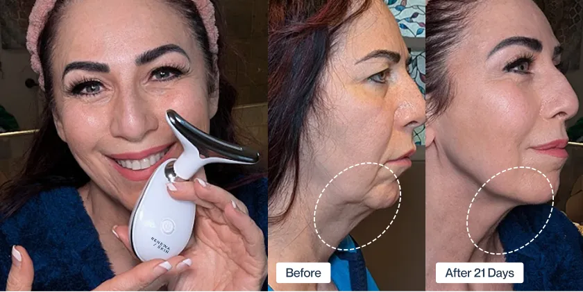 RenewaLift neck transformation