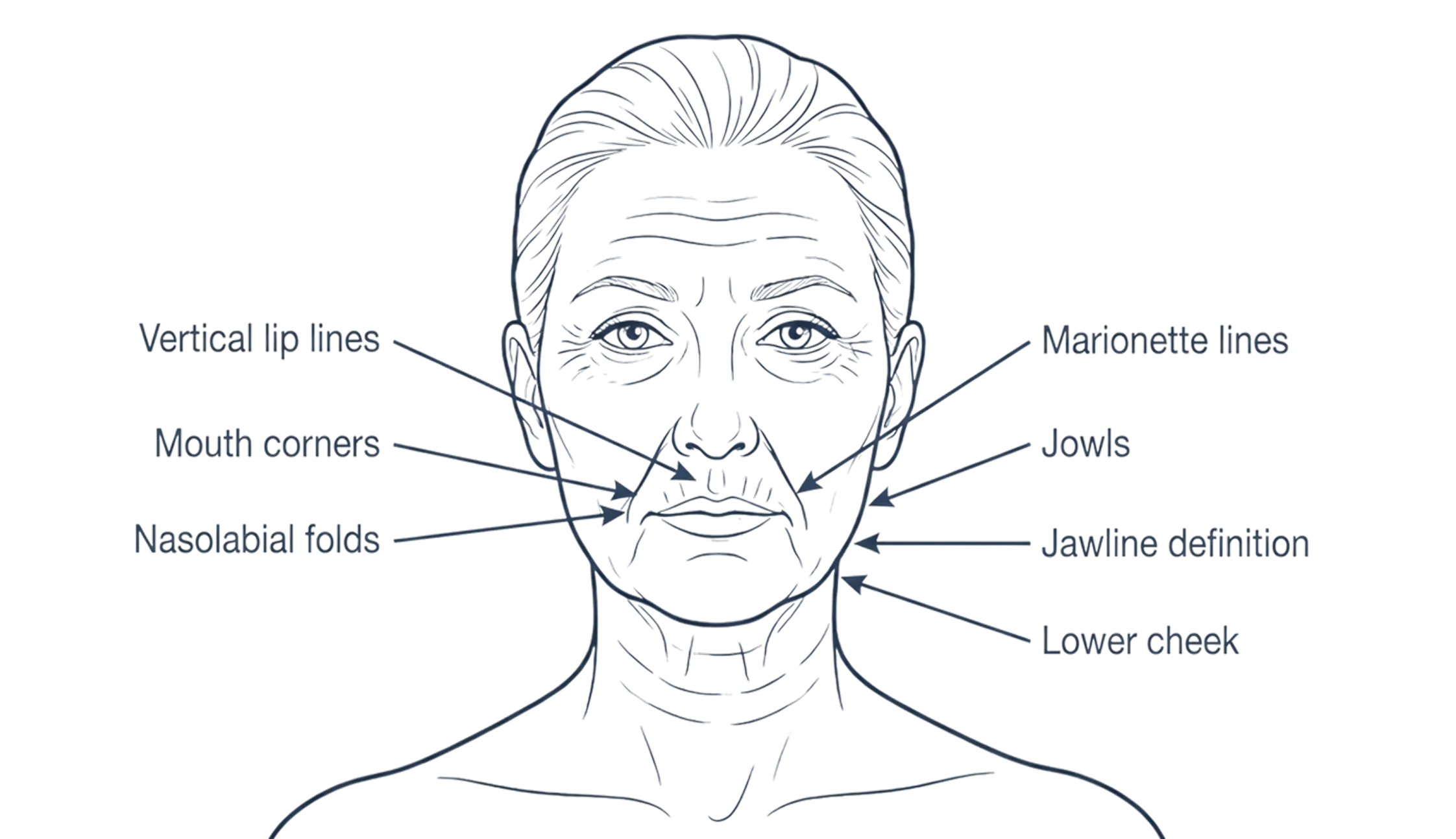 Diagram showing areas around the mouth, jawline and lower face