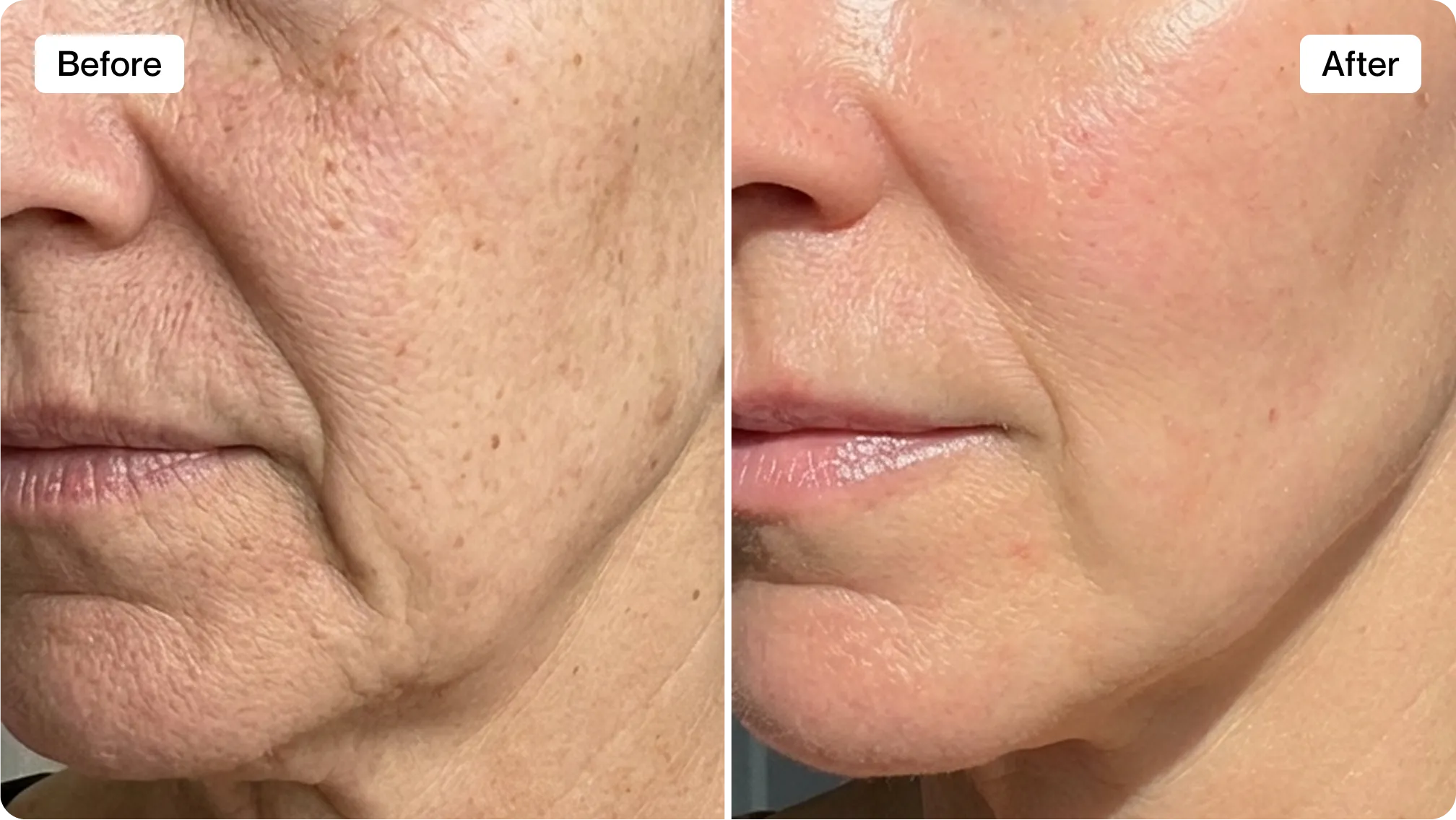 Before and after RenewaLift results