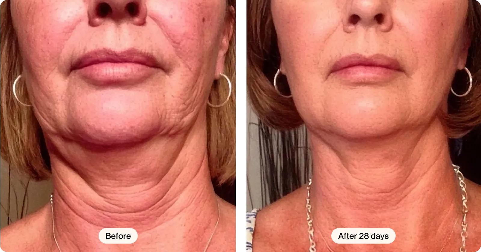 Neck and jawline before and after 28 days