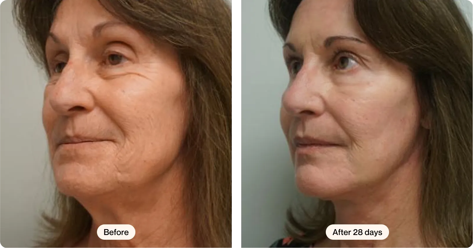 Before and after 28 days using RenewaLift