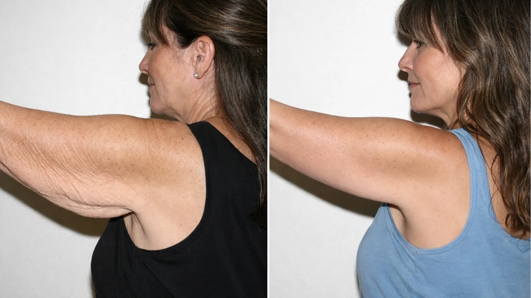 Woman’s arm after
