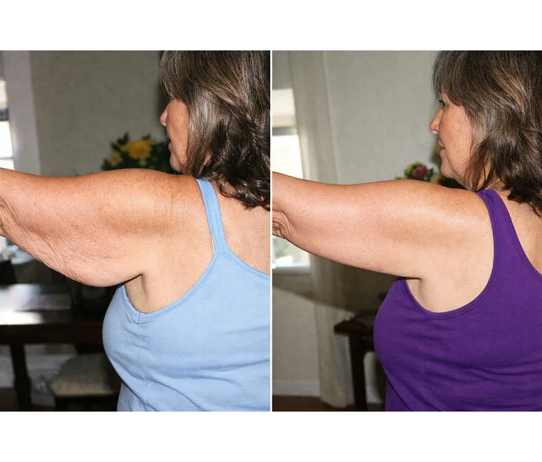 Customer using MyoGlow device
