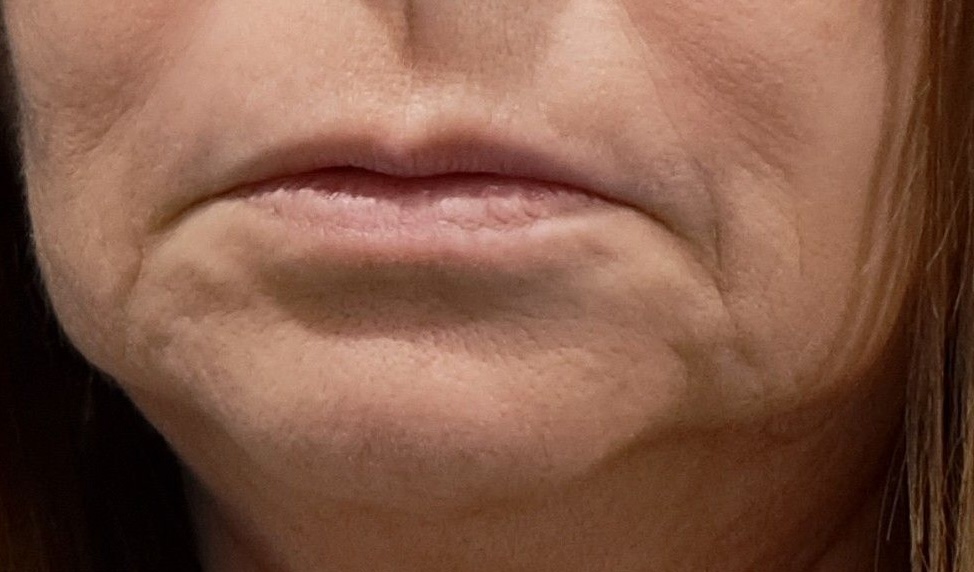 Saggy jowls