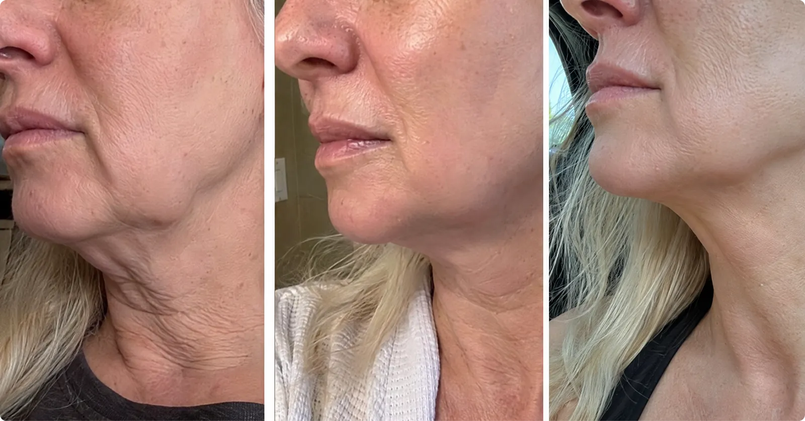 Thin lips before and after comparison