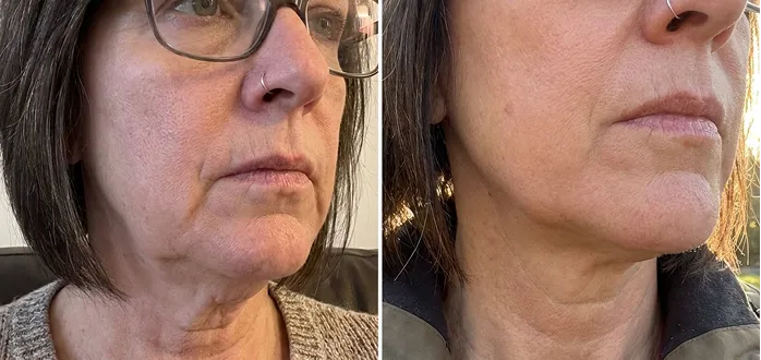 Kathleen lip before and after