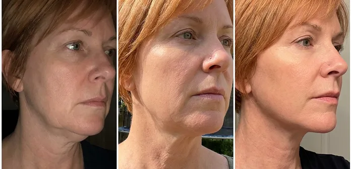 Denise lip before and after
