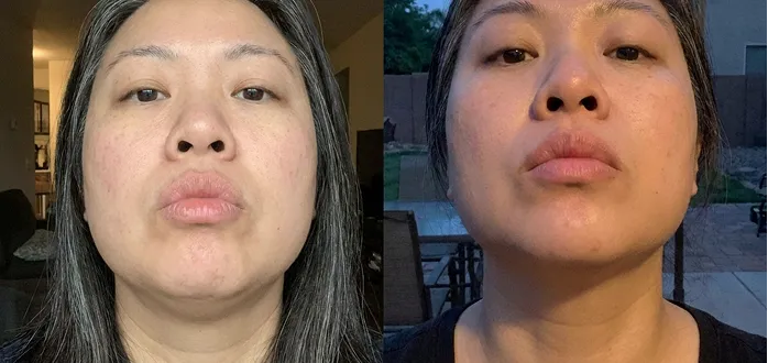 Marianne lip before and after