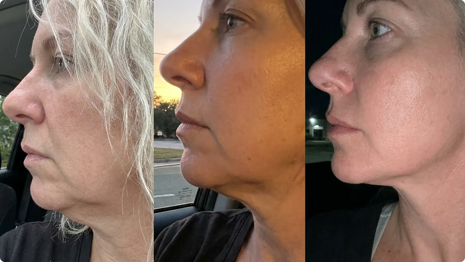 Women using LipFill™ Booster