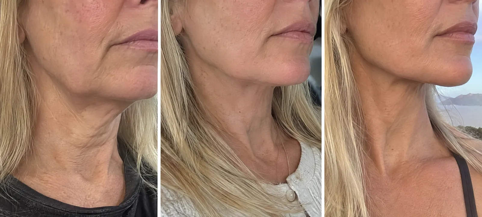 Lip transformation comparison