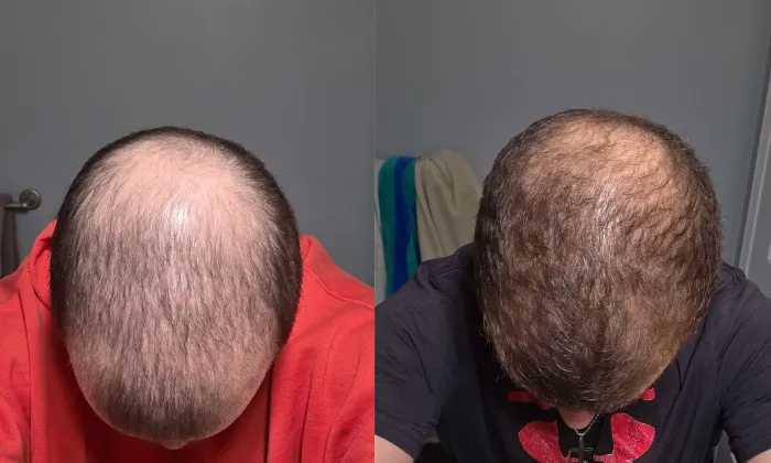 beforeafter-3.png — overall density