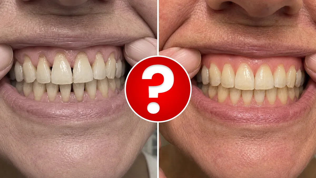 Gums before and after