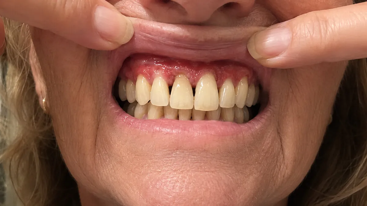 Day 1 gum line