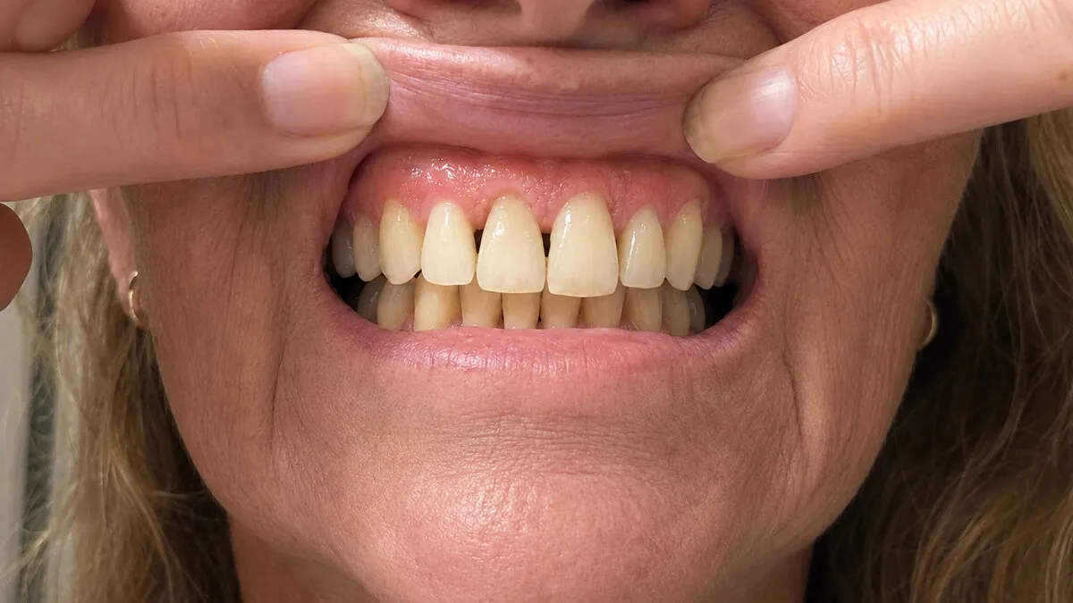 Day 30 gum line