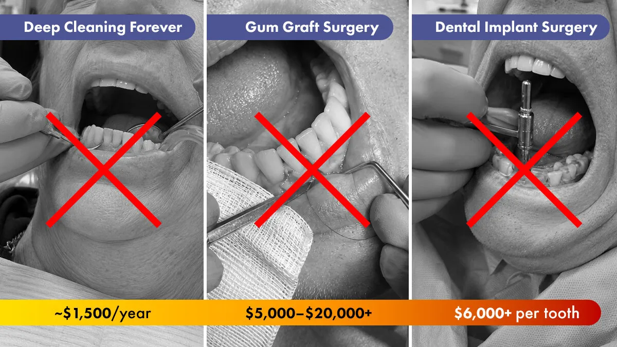 Deep cleaning, gum graft surgery and dental implant costs