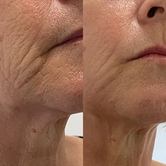 Before and After