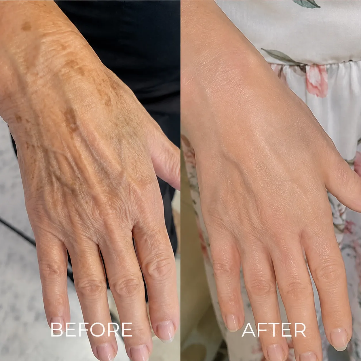 Crepey hands before and after Olavita