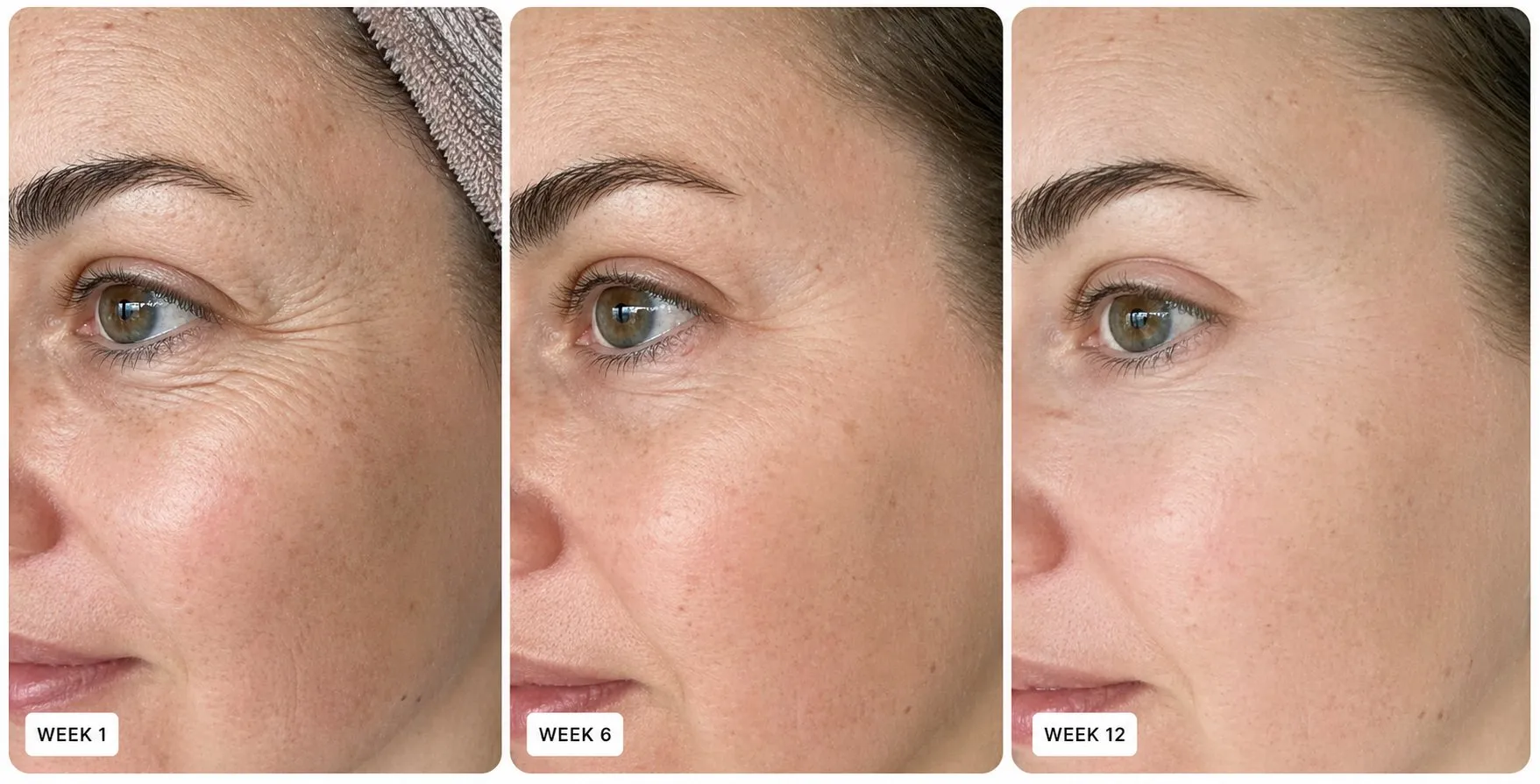 Before and after results from SoluRetinol — Week 1, Week 6, Week 12