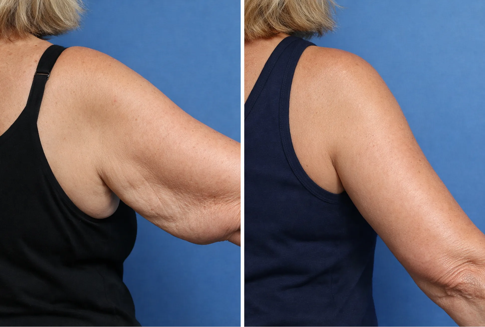 Flabby Arms Cause