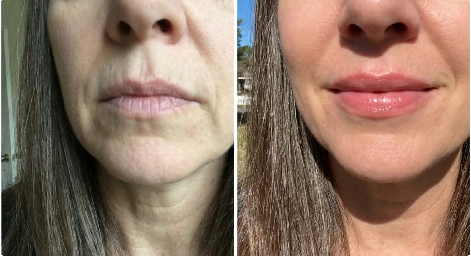 Lip before and after comparison