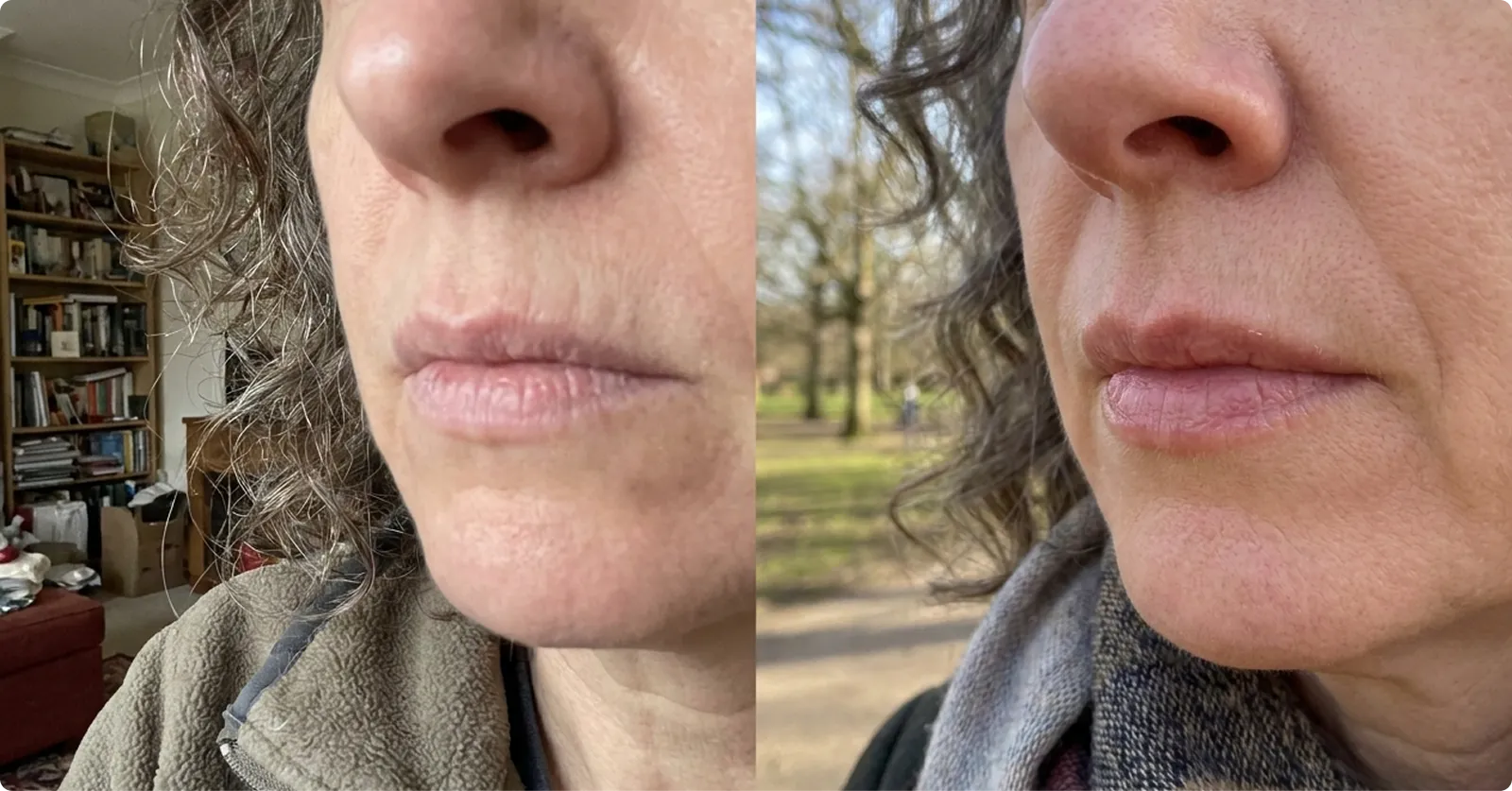 Thin lips before and after comparison