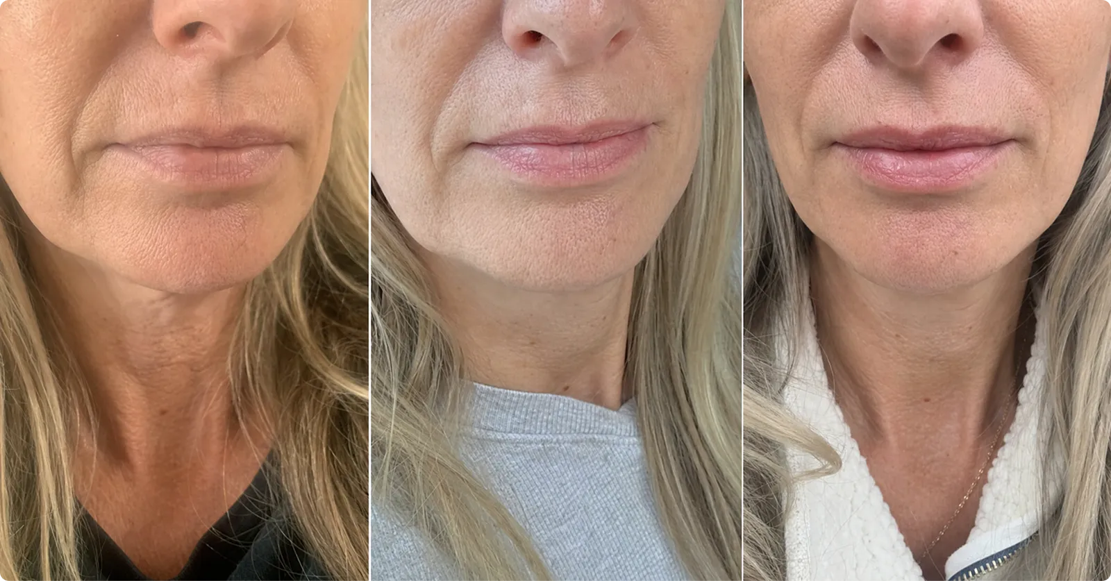 LipFill™ lip results
