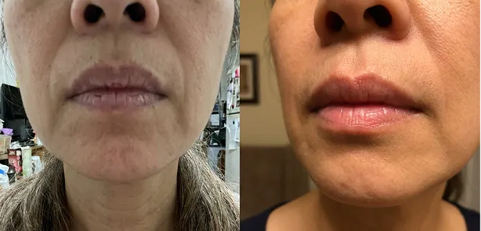 Denise lip before and after