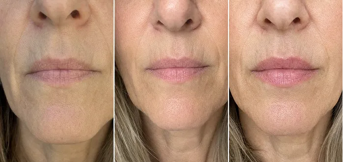 Marianne lip before and after