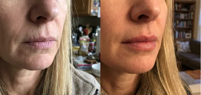 Kathleen lip before and after