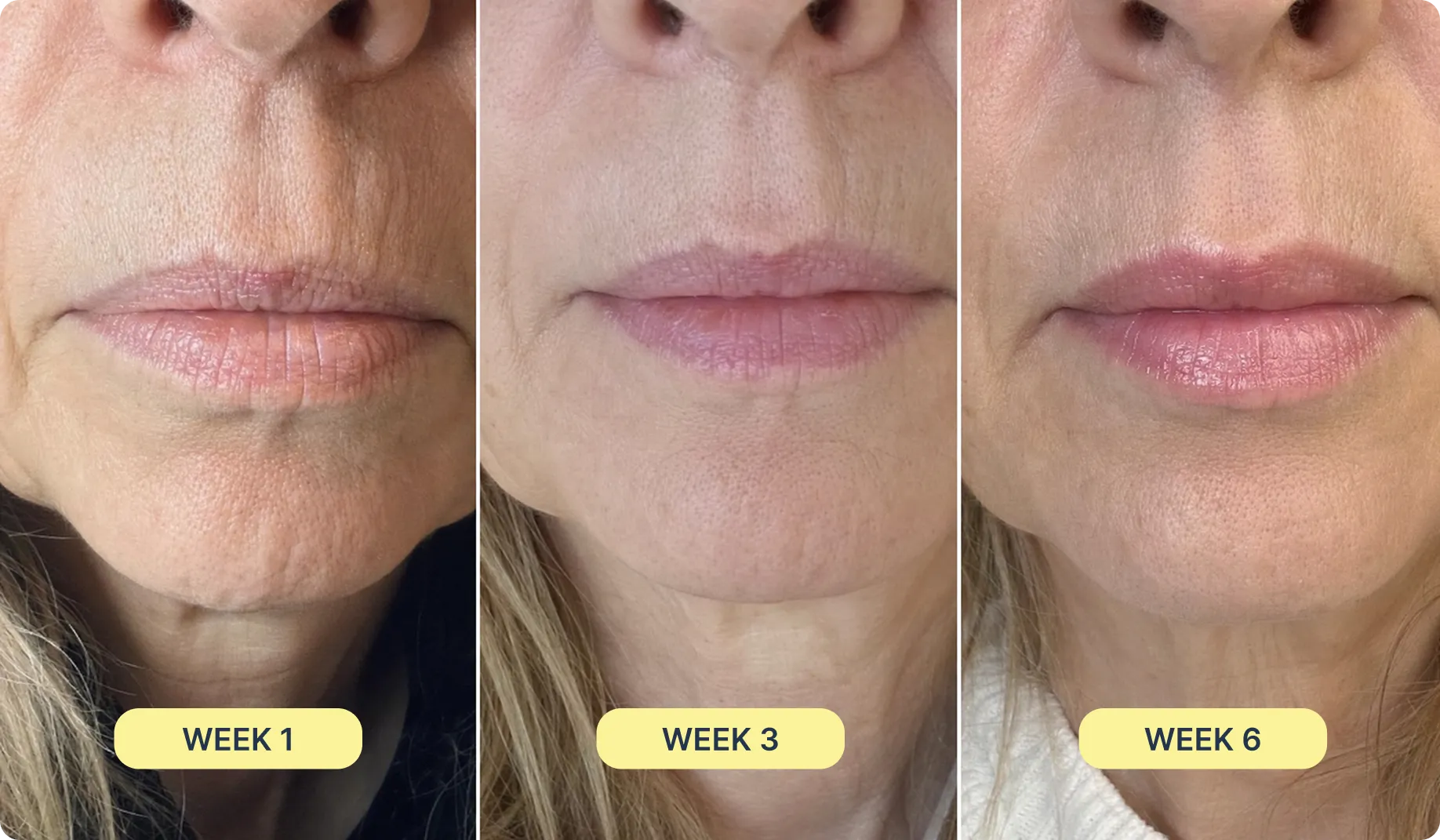 LipFill Booster results from week 1 to week 6