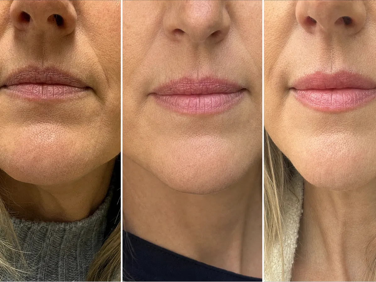 LipFill customer results