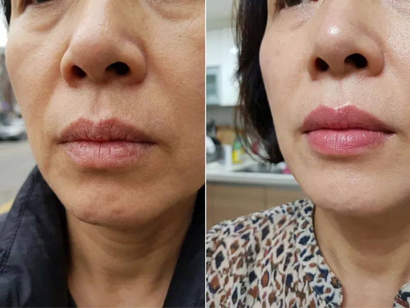 LipFill customer results