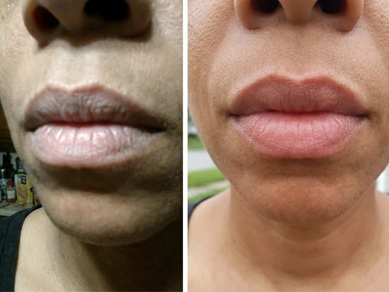 LipFill customer results