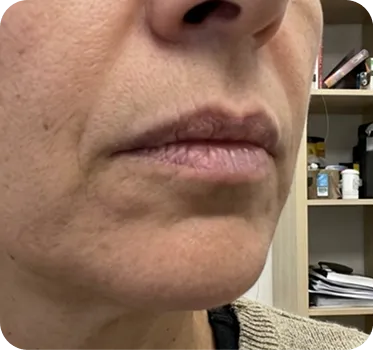 2 week LipFill results
